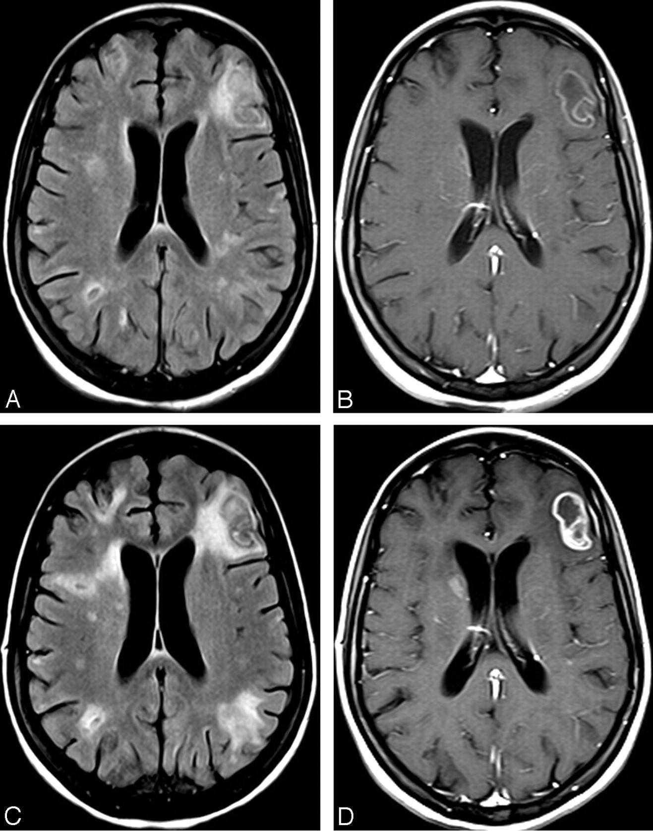 Токсоплазмоз - лечение у человека