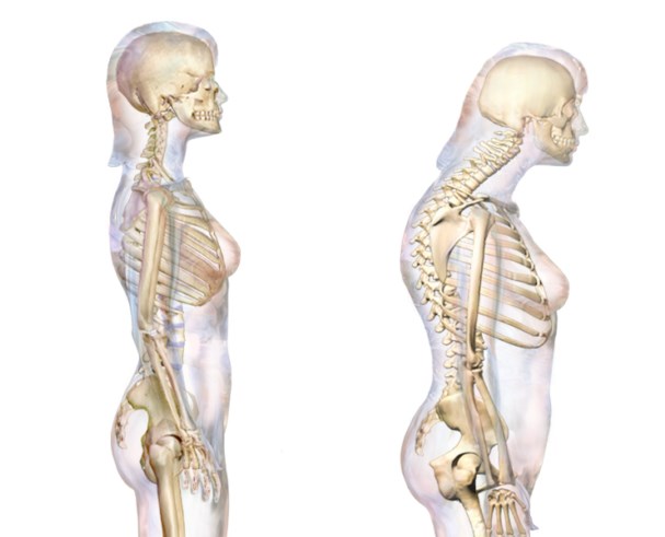 кифоз позвоночника